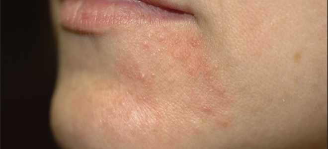 Сыпь вокруг рта (взрослые) — лечение внутренних проблем организма, все о гомеопатии