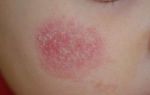 Причины образования красных шелушащихся и зудящих пятен на лице — самые частые причины, все о гомеопатии