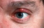 Болят глаза (при моргании) — причины и лечение, все о гомеопатии