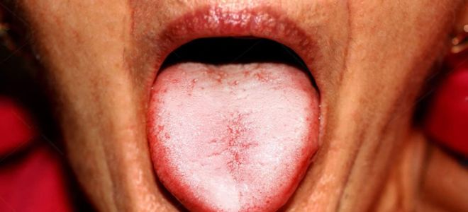 Белый налет на языке (взрослые) — причины появления, все о гомеопатии