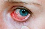Щиплет глаза — как избавиться от неприятных ощущений, все о гомеопатии