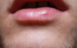 Красная точка на губе — причины и опасности, все о гомеопатии