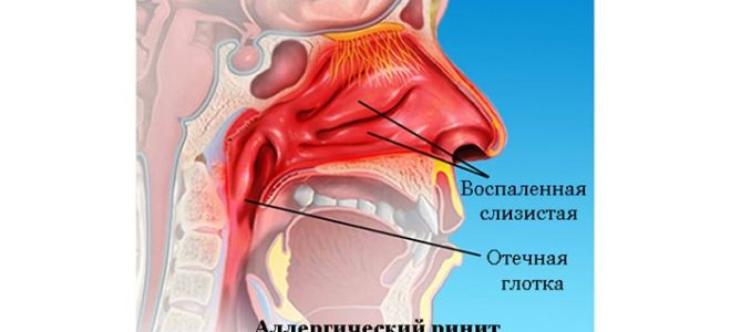 Заложенность носа без насморка — причины и терапия, все о гомеопатии