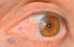 Краснеют белки глаз — на какой это указывает симптом, все о гомеопатии
