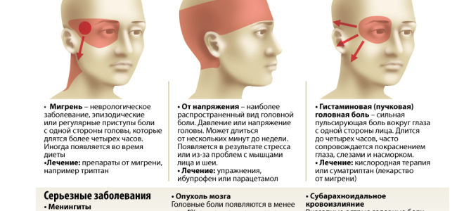 Почему давит на голову изнутри и как избавиться от неприятного ощущения — подход к лечению головной боли, все о гомеопатии