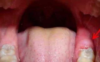 Опухла десна около зуба — особенности лечения, все о гомеопатии