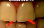 Трещины на зубах и зубной эмали — первые признаки заболевания, все о гомеопатии