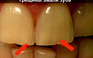 Трещины на зубах и зубной эмали — первые признаки заболевания, все о гомеопатии