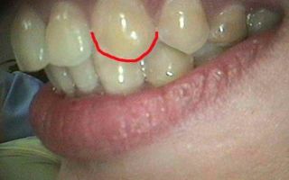 Онемение зубов верхней челюсти — что с этим делать, все о гомеопатии