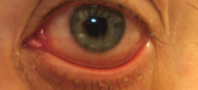 Прыщи на носу — все о гомеопатии