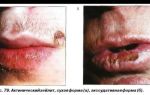 Воспаление красной каймы губ (Хейлит) — побледнения, мацерации с поперечными трещинами кожи, все о гомеопатии