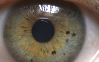 Пигментные пятна на радужке глаза — болезнь или особенность, все о гомеопатии