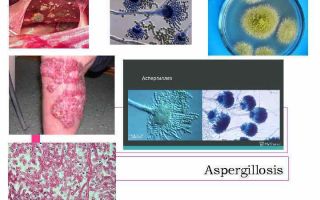 Аспергиллёз (Aspergillus) — грибковая инфекция аспергиллы, все о гомеопатии