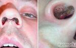 Сухость и корочки в носу (взрослые) — активная борьба с недугом, все о гомеопатии
