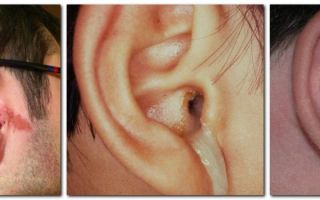 Что делать, если течет ухо и чем его лечить? — как быстро облегчить своё состояние, все о гомеопатии