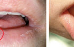 Белый налет на губах (взрослые) — причины появления слизистой, все о гомеопатии