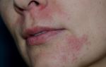 Раздражение вокруг рта (взрослые) — основные причины, все о гомеопатии