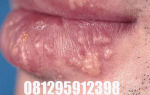 Герпес на губах — вирусная ползучая, распространяющаяся кожная болезнь — все о гомеопатии