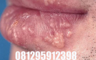 Герпес на губах — вирусная ползучая, распространяющаяся кожная болезнь — все о гомеопатии