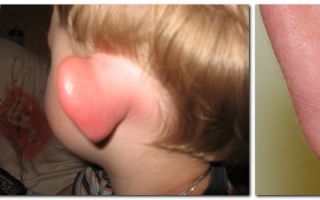 Что делать, если у ребенка краснеют и опухают уши — возможные причины заболевания, все о гомеопатии