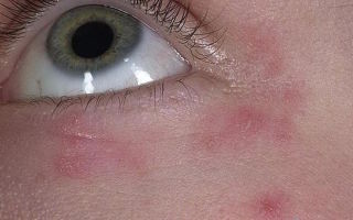 Сыпь под глазами (взрослые) — особенности патологической реакции, все о гомеопатии