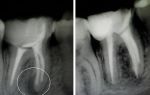 Воспаление корня зуба — что можно предпринять в домашних условиях от боли, все о гомеопатии
