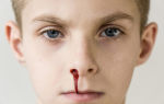 Запах крови в носу — причины кровотечения, все о гомеопатии