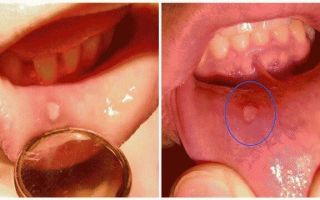 Стоматит (от др.- рот) — белые язвочки во рту, все о гомеопатии