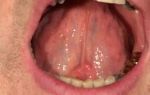 Воспаление под языком — причины и лечение слюнной железы, все о гомеопатии