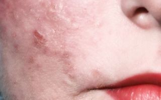 Покраснение и шелушение кожи вокруг носа — в каких местах проявляется и что можно предпринять, все о гомеопатии
