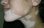 Причины появления белых пятен на лице — нарушение пигментации, выражающееся в исчезновении пигмента меланина на отдельных участках кожи, все о гомеопатии