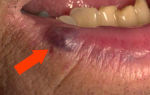 Синяя точка на губе — «венозное озерцо», все о гомеопатии