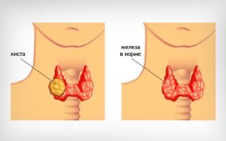 Киста и узлы щитовидной железы — в чем разница и какие особенности, все о гомеопатии