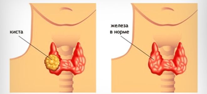 Киста и узлы щитовидной железы — в чем разница и какие особенности, все о гомеопатии