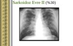 Саркоидоз (болезнь Бенье) — аутоиммунное заболевание, все о гомеопатии