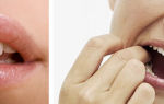 Немеют губы (верхняя, нижняя) — что при этом  делать, все о гомеопатии