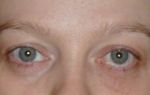 Двоится в глазах (симптомом диплопии) — человек видит двойной контур одного и того же предмета, все о гомеопатии