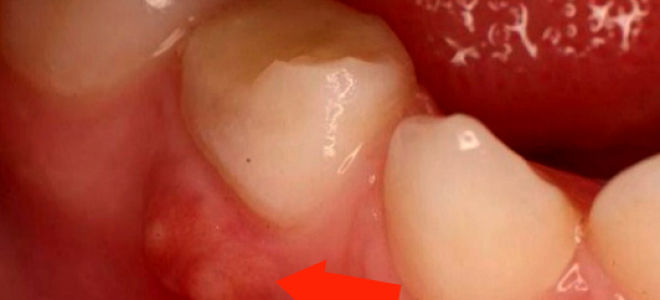 Шишка на десне — причины появления патологии, все о гомеопатии