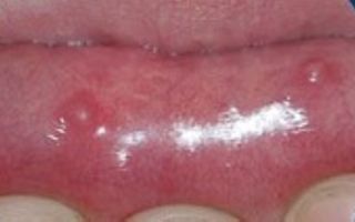 Пузырек  (прозрачный) на внутренней стороне губы — что означает, все о гомеопатии