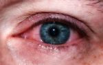 Красные глаза (по утрам) — какие причины, все о гомеопатии
